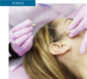 Pose de fils tenseurs Ultra V réalisée en médecine esthétique